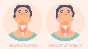 Hypothyroidism: Symptoms, Diagnosis, and Treatment